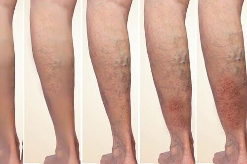 Suy giãn tĩnh mạch có thể kiểm soát nếu phát hiện sớm, điều trị đúng cách Suy giãn tĩnh mạch có thể kiểm soát nếu phát hiện sớm, điều trị đúng cách