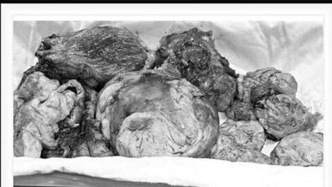 Bóc khối u xơ nặng 2,7kg, giữ lại tử cung cho bệnh nhân từng 2 lần sinh mổ