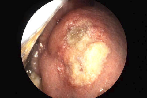 Loét lưỡi không liền, bệnh nhân phát hiện ung thư