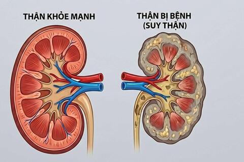 10 dấu hiệu của bệnh thận dễ bị bỏ qua