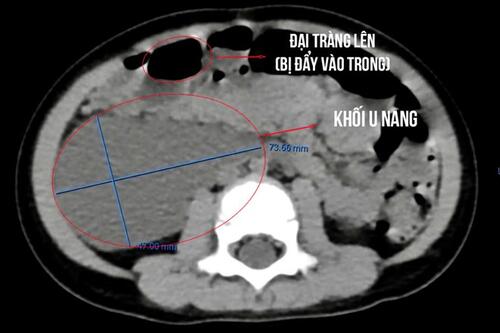 Cháu bé 26 tháng tuổi mang u nang lớn hiếm gặp