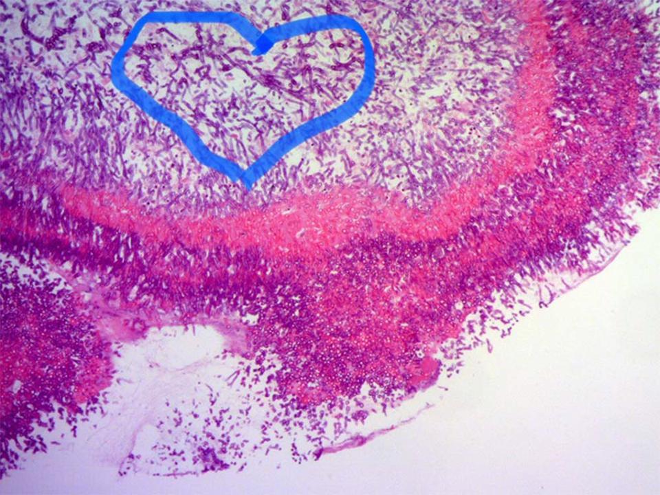 Hình ảnh nấm Aspegillus fumigatus trên tiêu bản nhuộm soi giải phẫu bệnh.