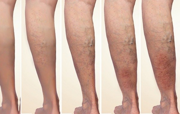 Suy giãn tĩnh mạch có thể kiểm soát nếu phát hiện sớm, điều trị đúng cách